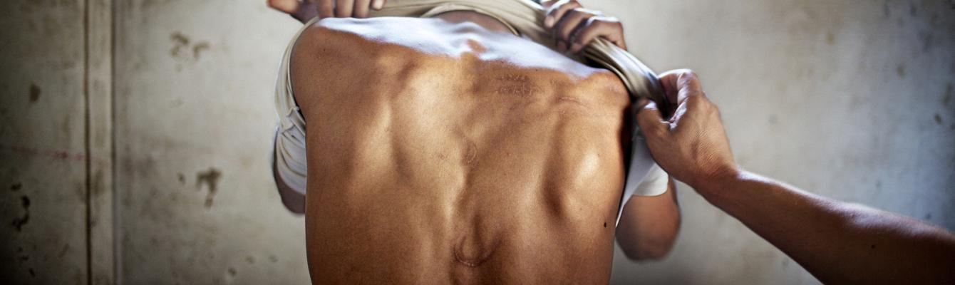 Torture scars on a survivor's back in a cell 