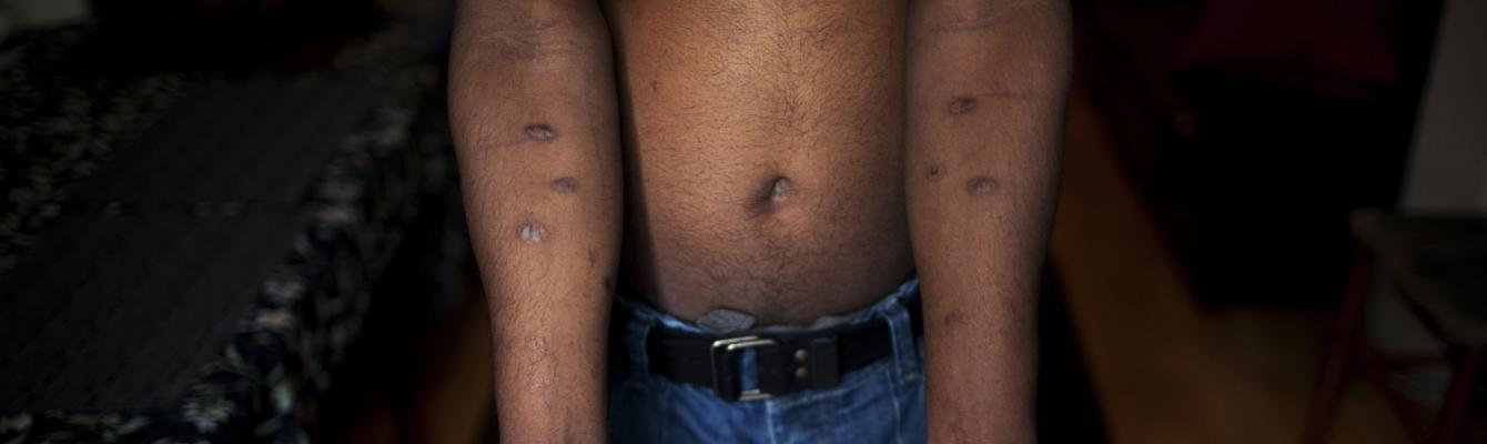 Scars from torture