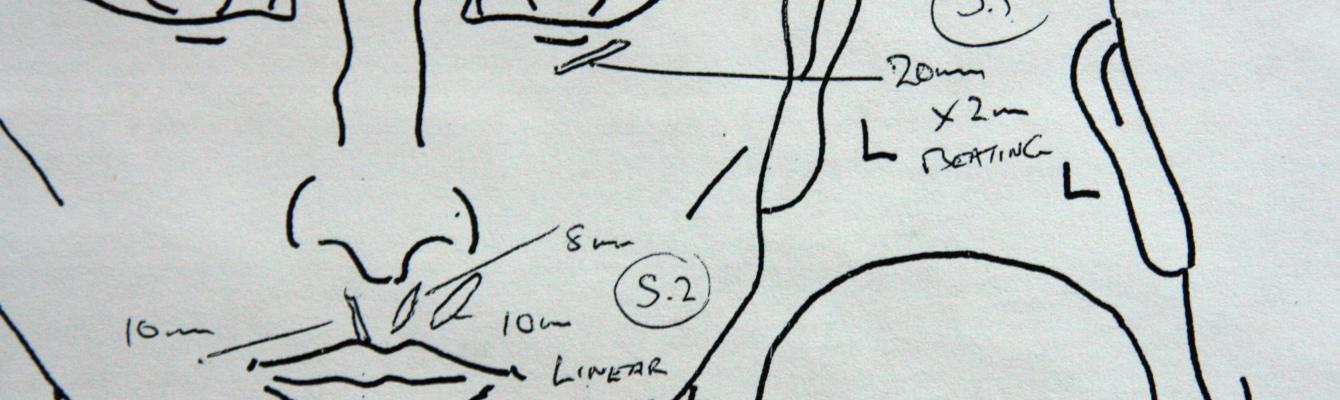 An medical drawing of the face and head used to record scars for a medico-legal report