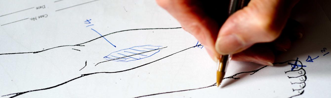 A medico-legal report diagram documenting scars from torture on a person's leg