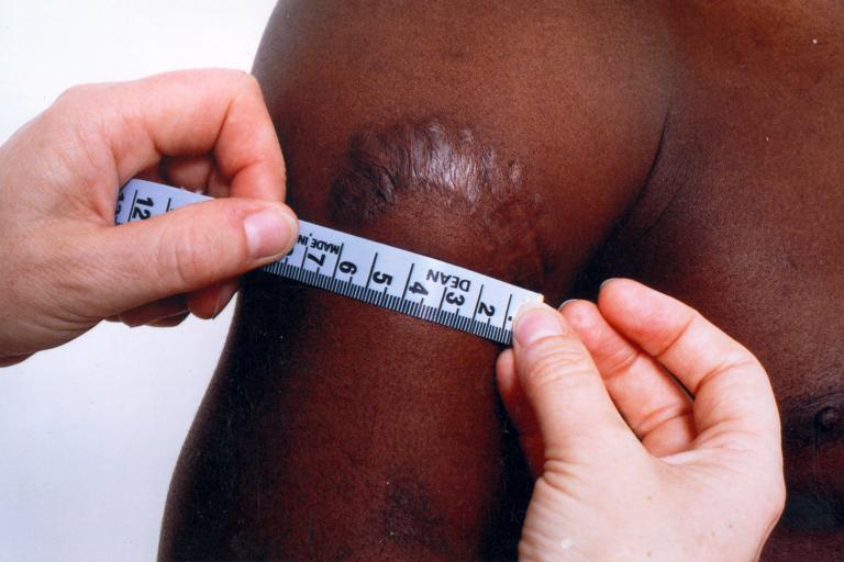 A survivor has a scar on his arm measured
