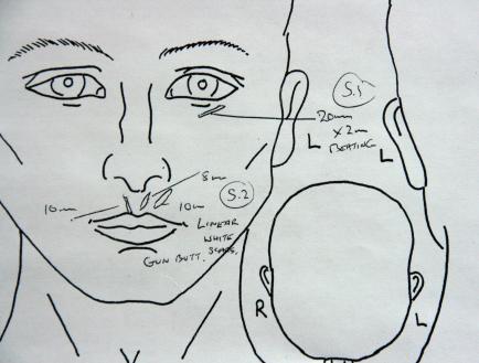 An medical drawing of the face and head used to record scars for a medico-legal report