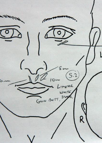 An medical drawing of the face and head used to record scars for a medico-legal report