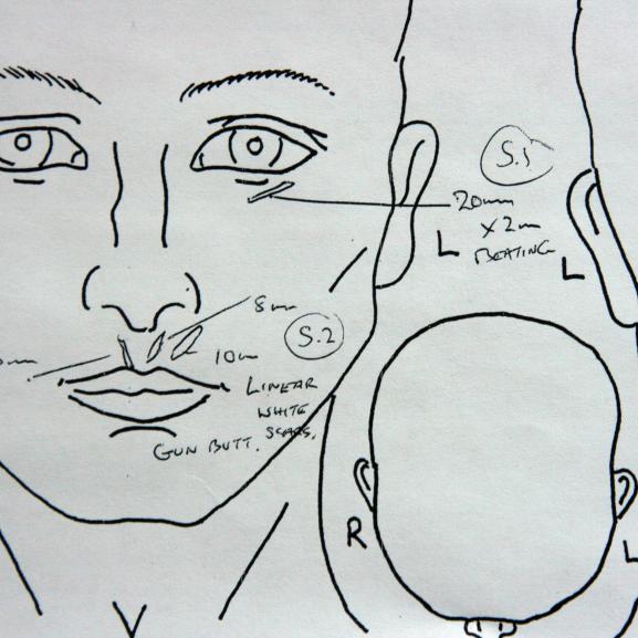 An medical drawing of the face and head used to record scars for a medico-legal report