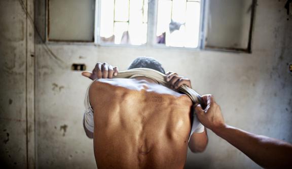 Torture scars on a survivor's back in a cell 