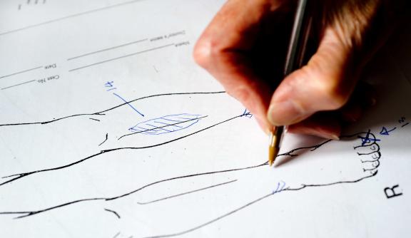 A medico-legal report diagram documenting scars from torture on a person's leg